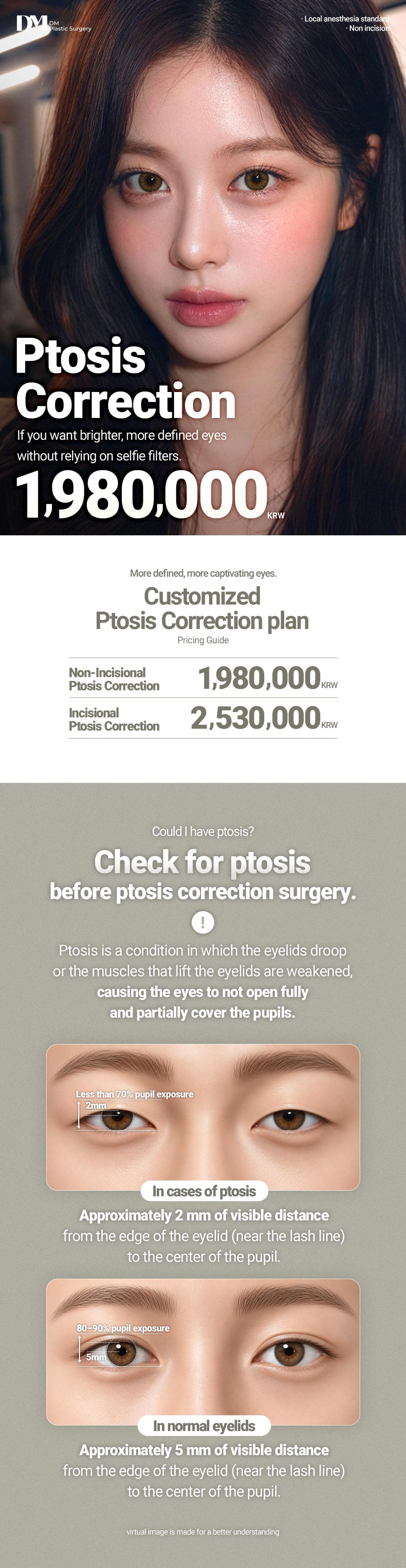 Koreksi Ptosis Mata (Tanpa Sayatan) 1