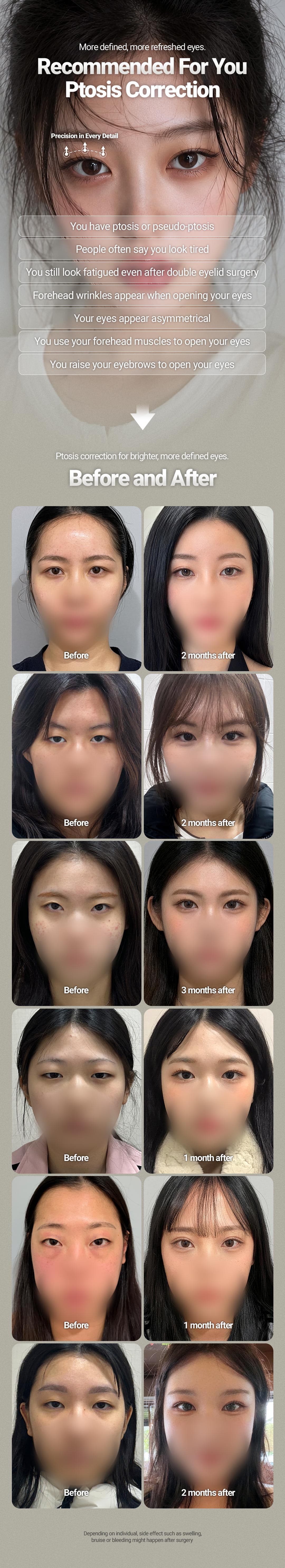 Koreksi Ptosis Mata (Tanpa Sayatan) 3