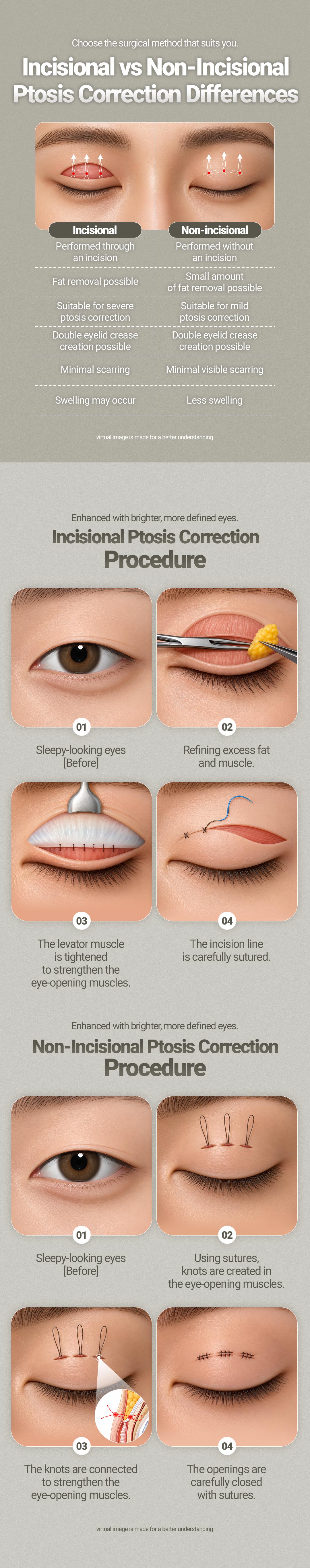 Koreksi Ptosis Mata (Tanpa Sayatan) 5
