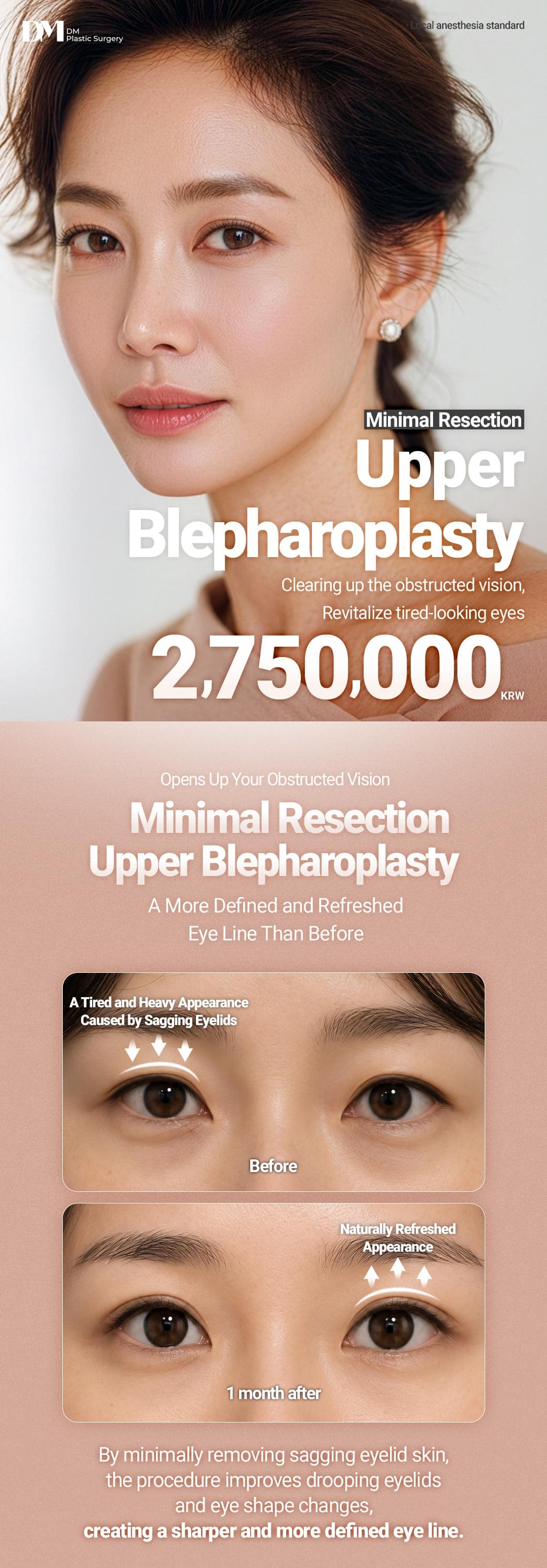 Upper Blepharoplasty 1