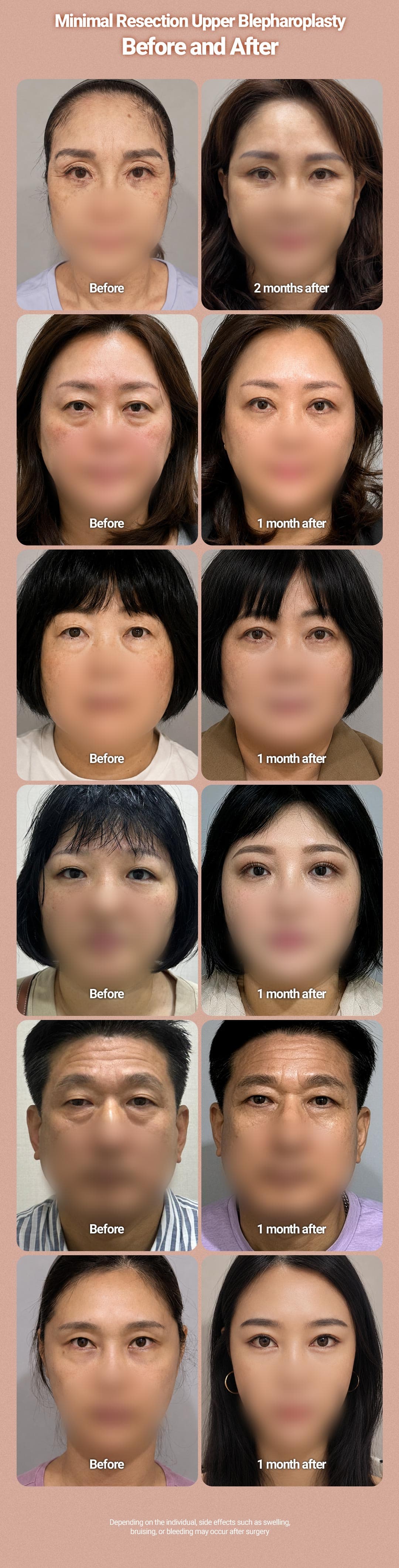 Upper Blepharoplasty 3