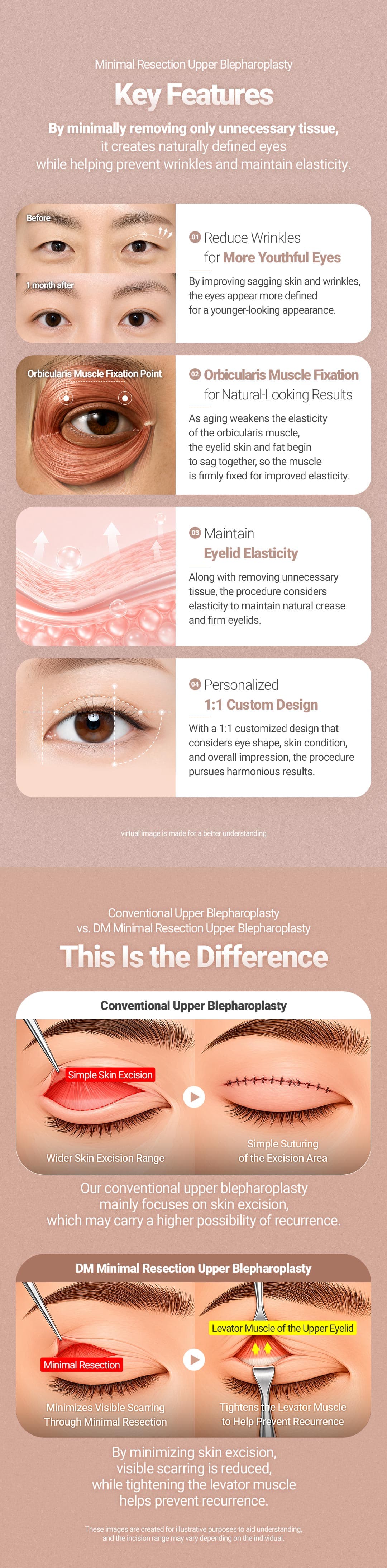 Upper Blepharoplasty 2