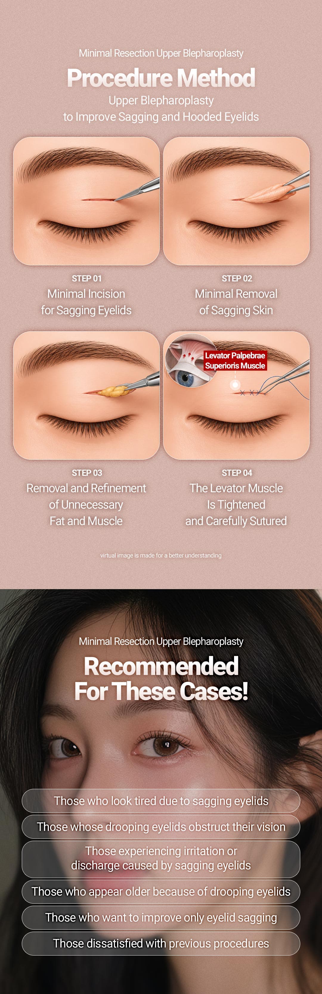 Upper Blepharoplasty 5