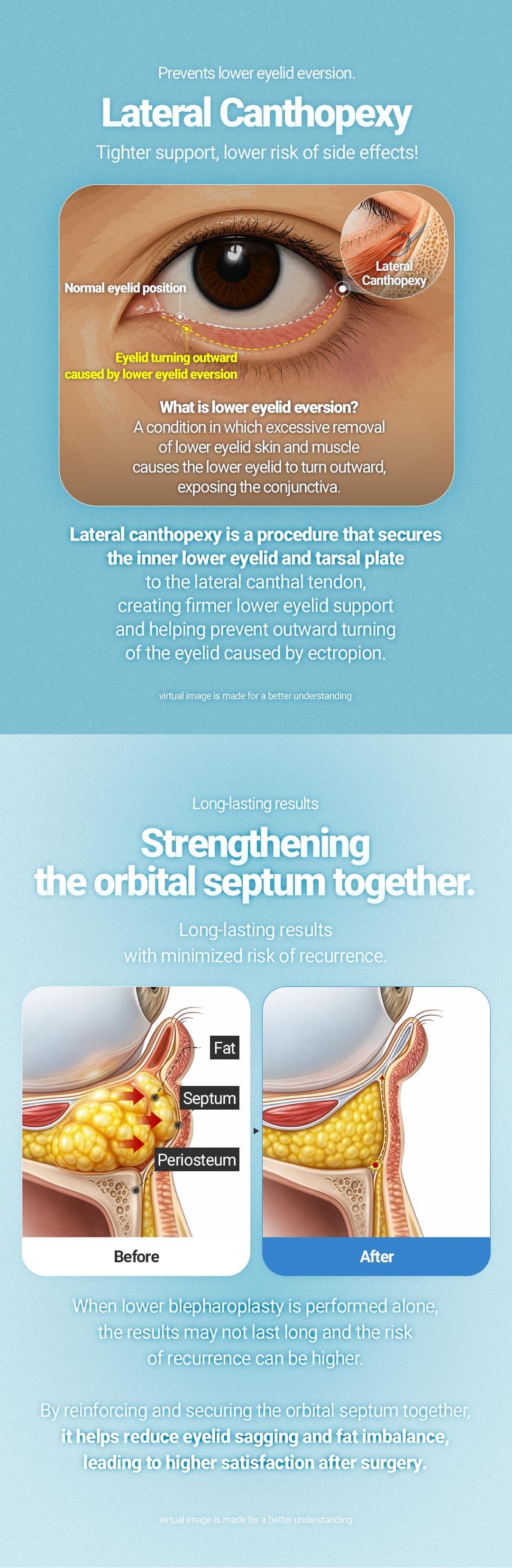 Lower Blepharoplasty 3