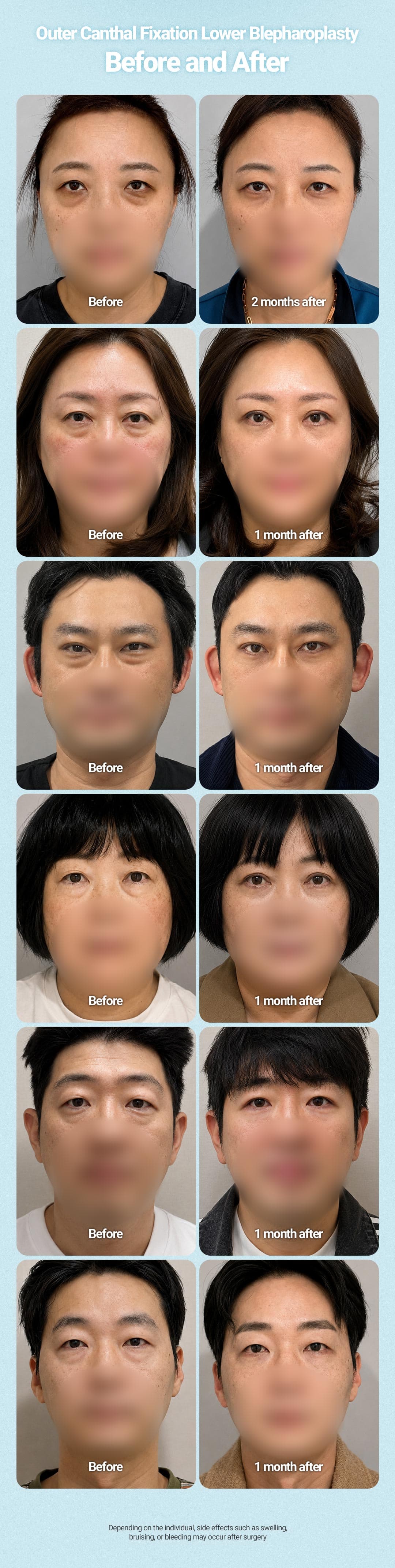 Lower Blepharoplasty 2
