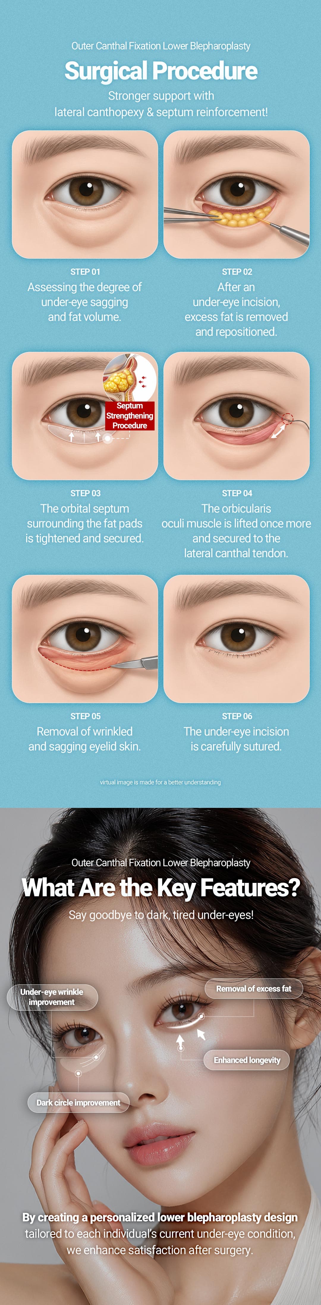 Lower Blepharoplasty 4