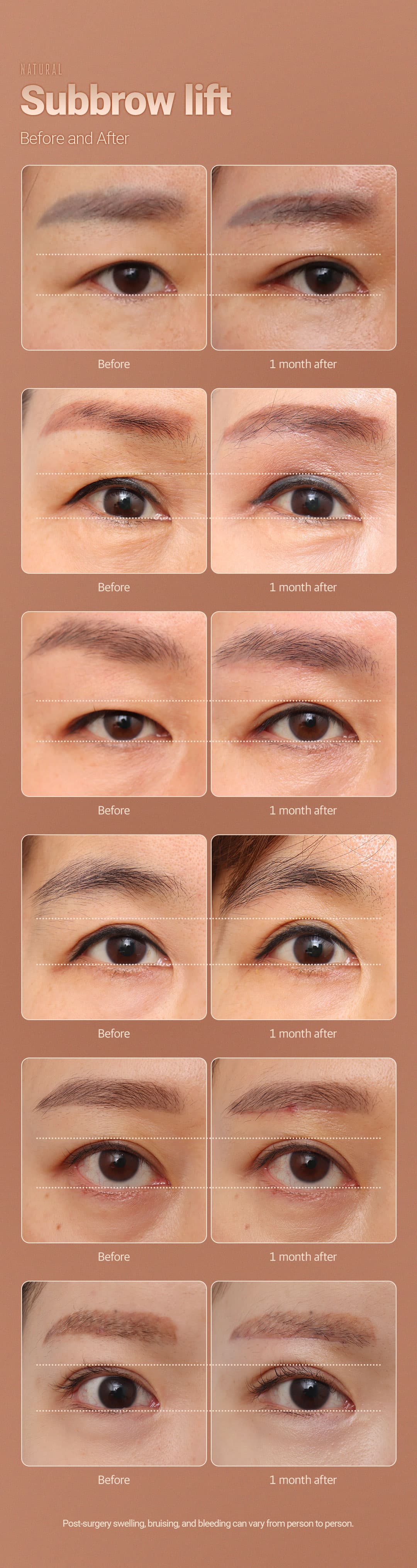 การยกคิ้วใต้ผิวหนัง 3