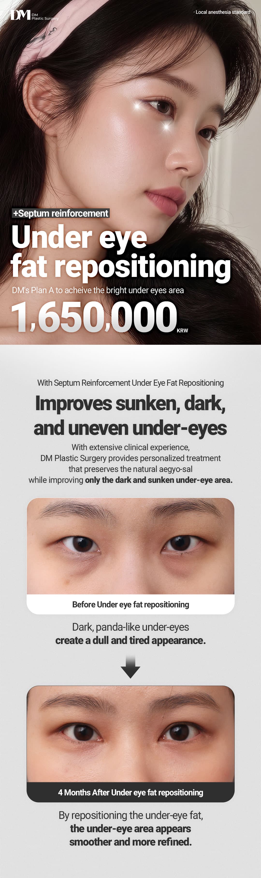 Lower eyelid fat repositioning 2