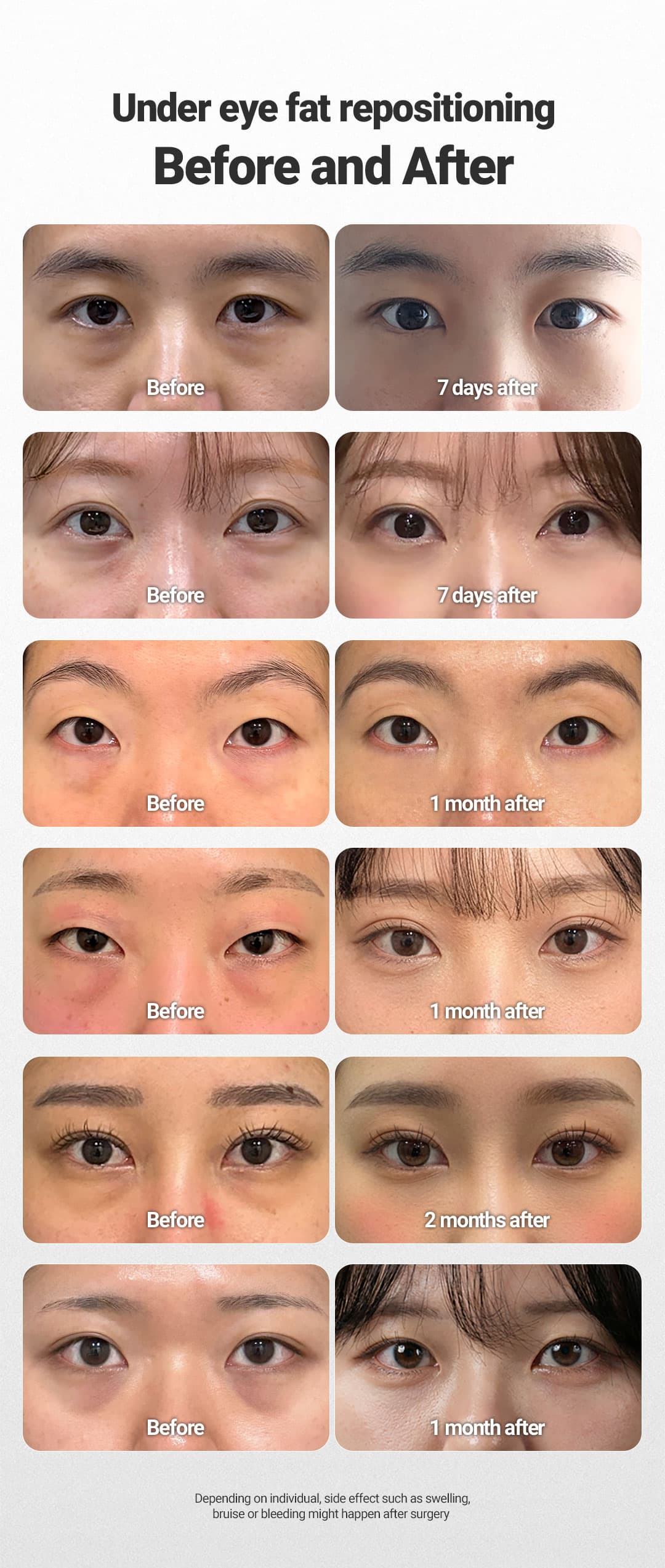 Lower eyelid fat repositioning 1