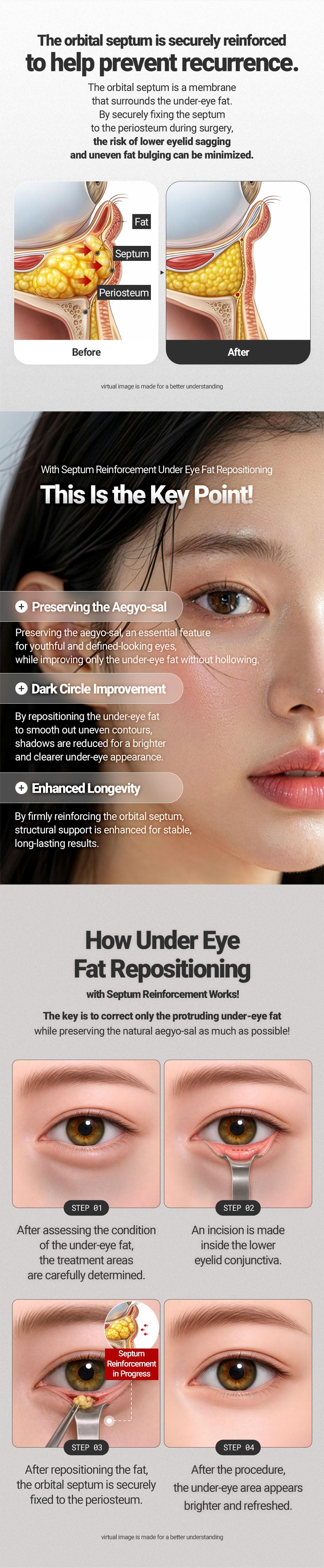 Lower eyelid fat repositioning 3