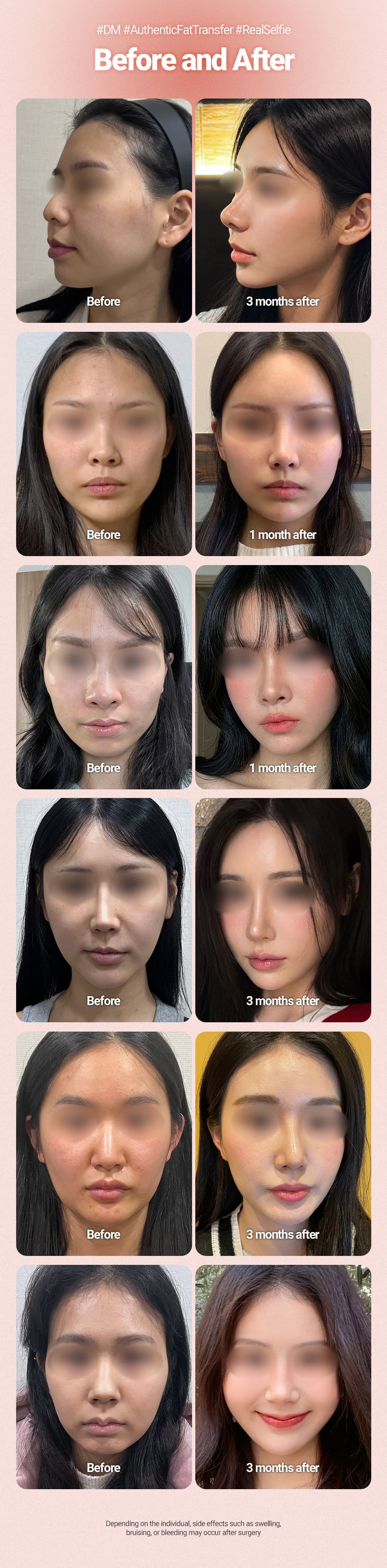 การปลูกถ่ายไขมันทั่วใบหน้า 2