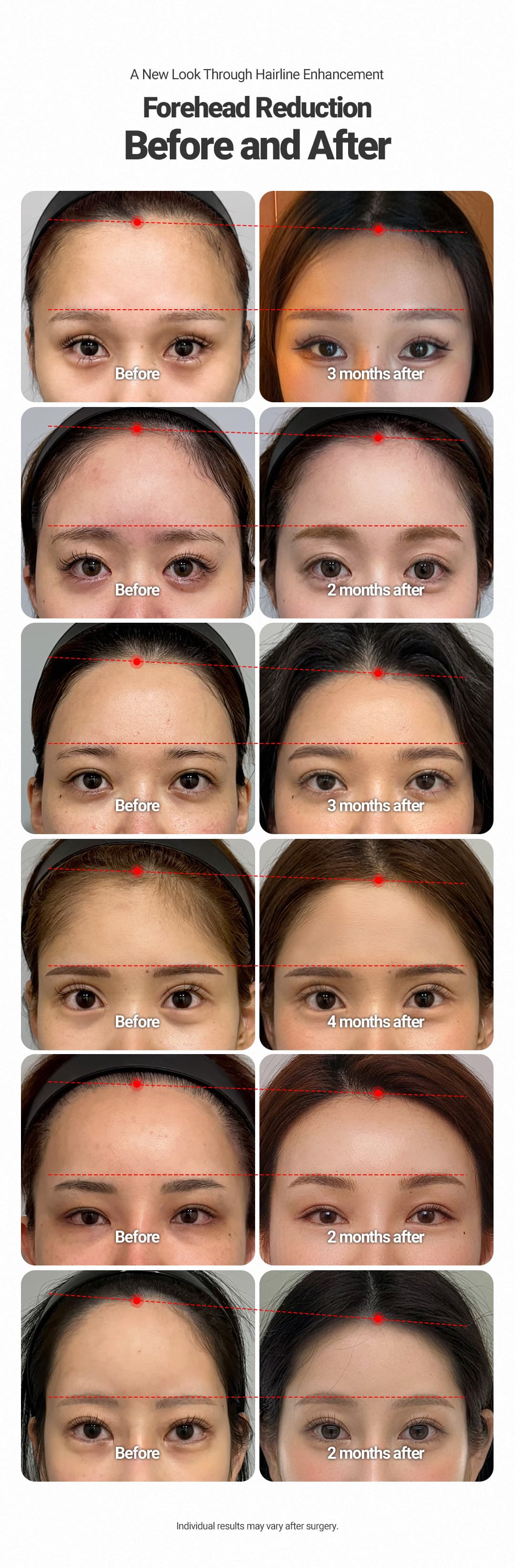 Forehead Reduction 3