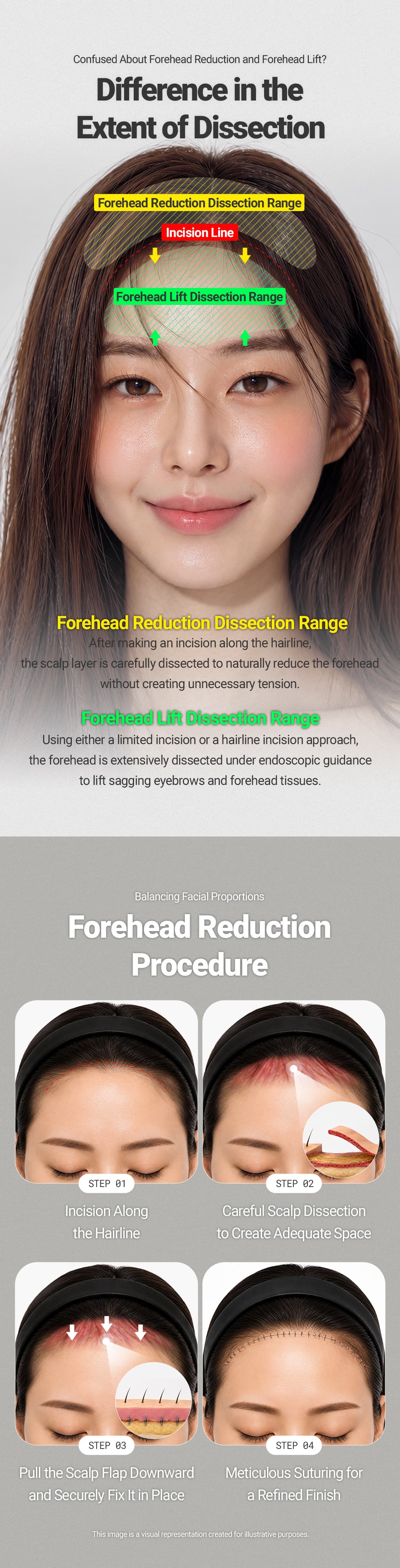 Forehead Reduction 4