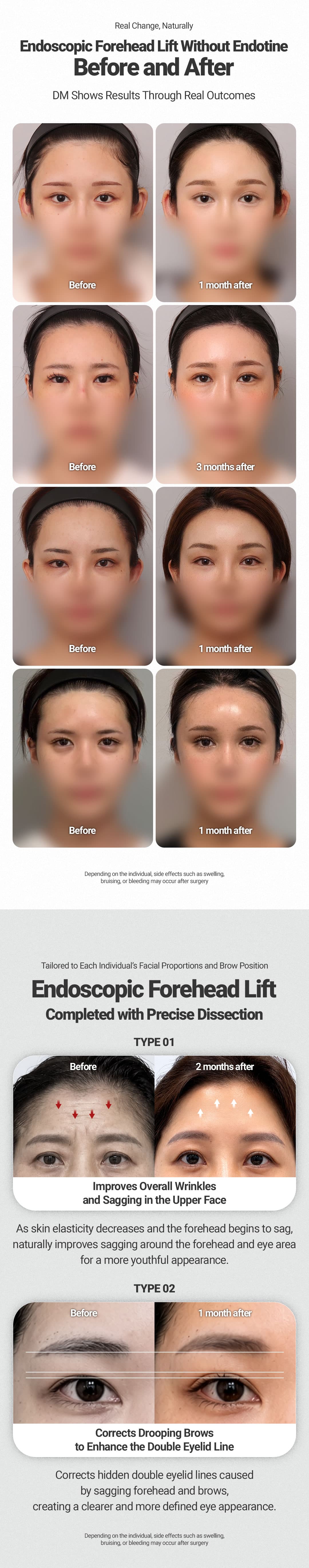 Endoscopic Forehead Lifting 3