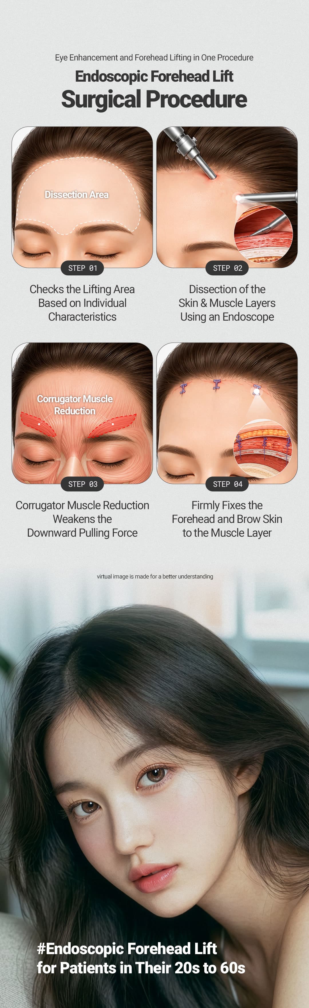 Endoscopic Forehead Lifting 4