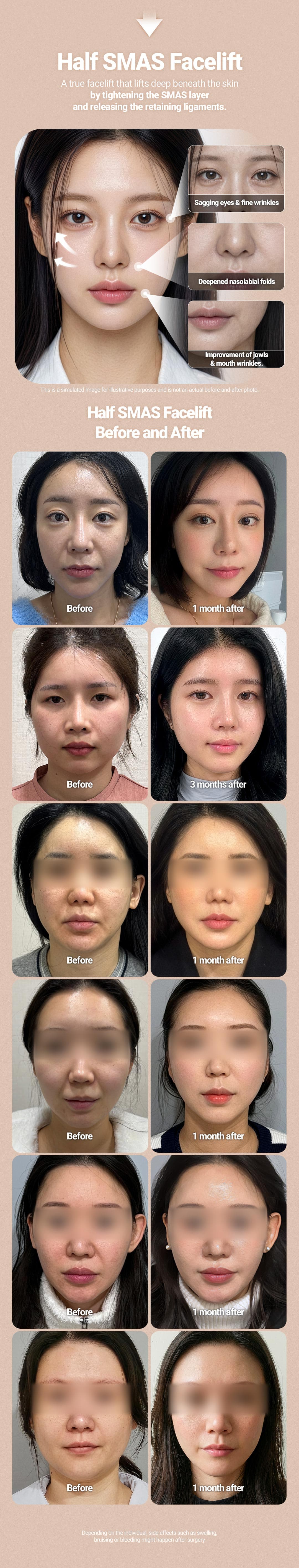Half Face Lift 2