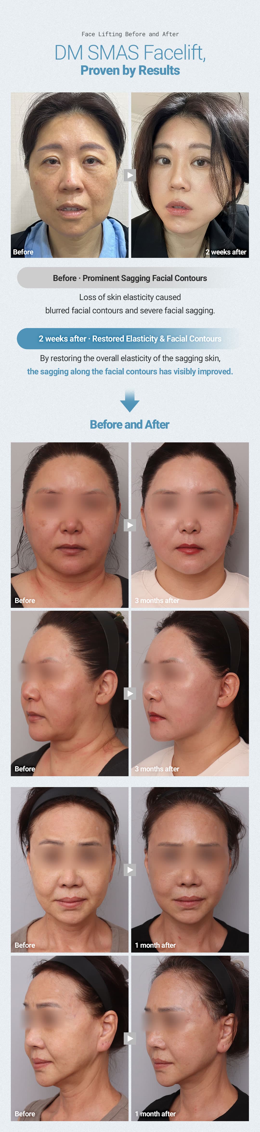 SMAS Facelift 3