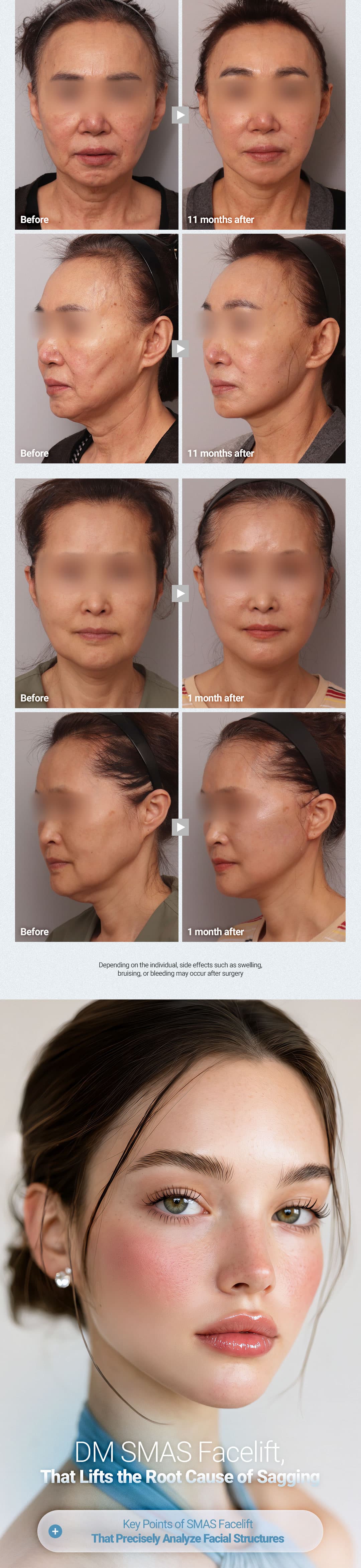 SMAS Facelift 1