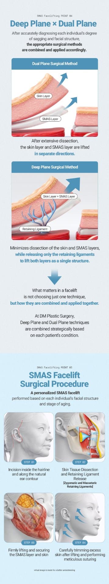 SMAS Facelift 5