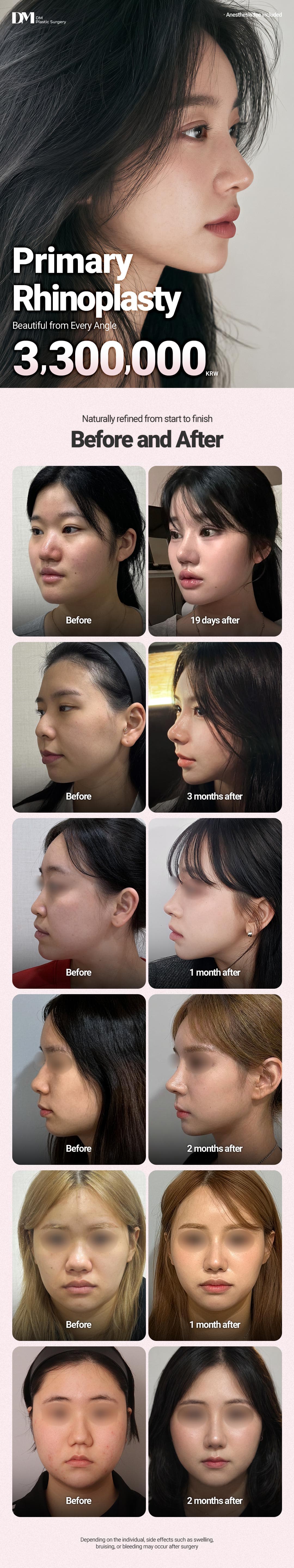 (First-time) Rhinoplasty 3