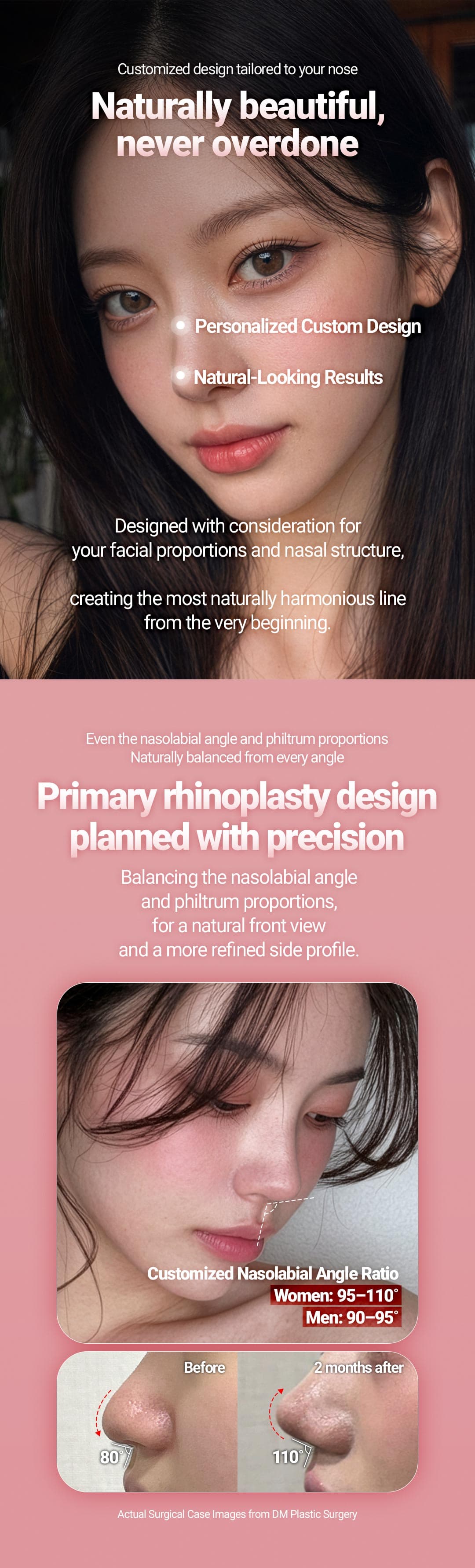 (First-time) Rhinoplasty 2