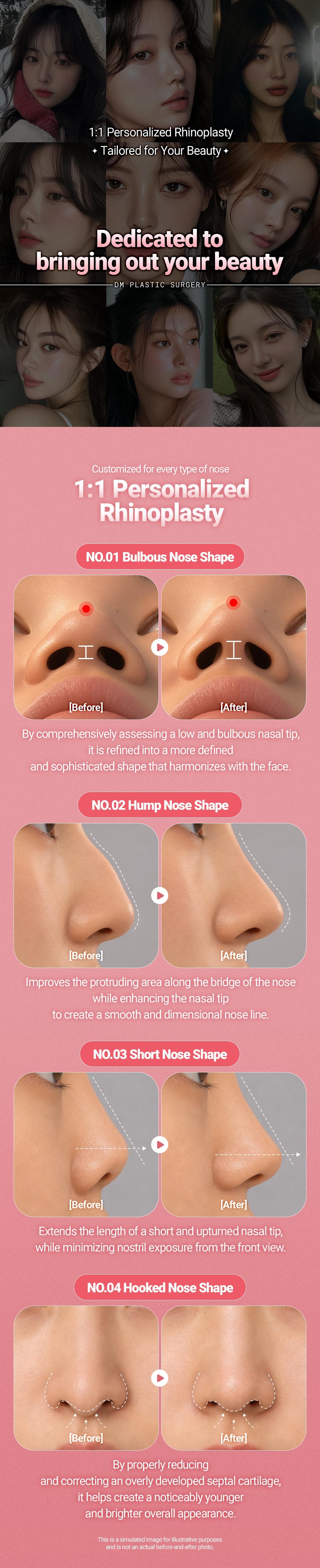 (First-time) Rhinoplasty 4