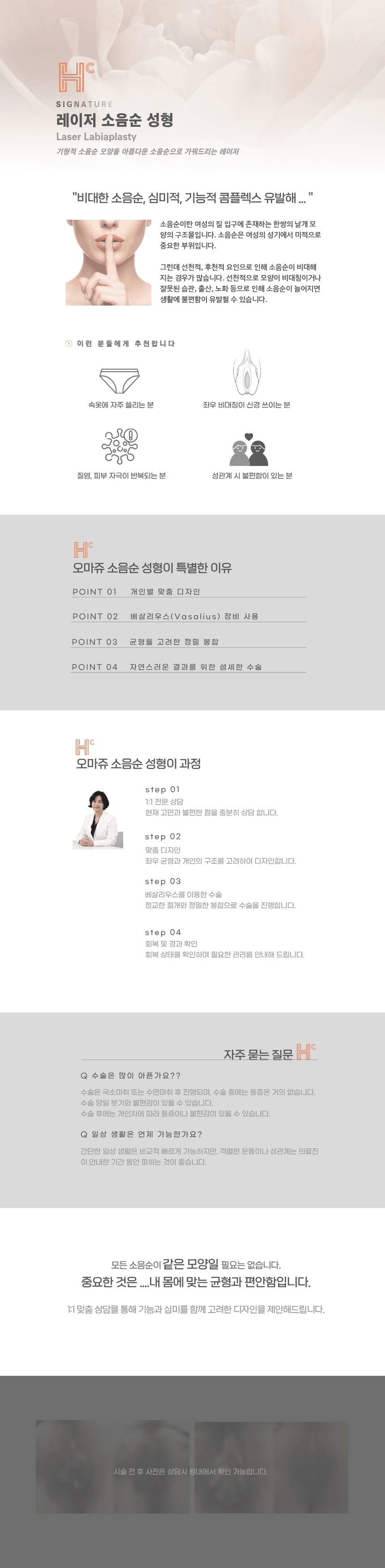 소음순 레이저 조각 성형 "섬세하게 다듬는, 균형잡힌 변화" 1