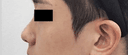 만족하고 쓰는 남자 코실리프팅 후기
