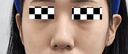 눈밑필러 앞볼필러 대만족 ㅎㅎ