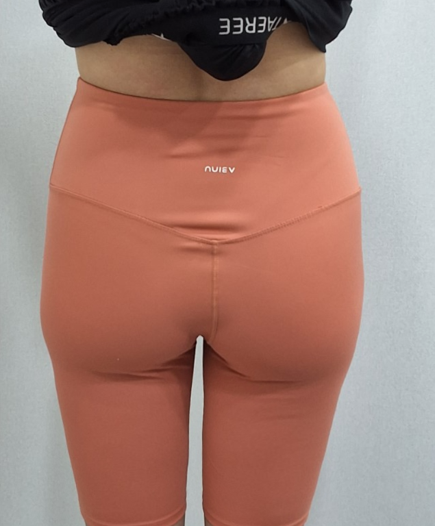 골반 힙딥 엉덩이 필러 전 후 핏 차이 봐주세요!😉