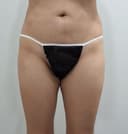 골반필러잘하는곳 찾다 정착, 힙딥필러 하고 라인 달라짐