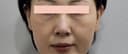 코실리프팅이랑 눈밑필러로 회춘했네요 ㅎㅎ