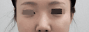 눈두덩이+눈밑+앞볼필러 맞고 피곤해 보이는거 싹 사라졌어요!!