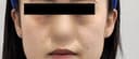 눈꺼짐고민 눈밑필러잘하는곳에서 해결