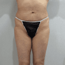 무너진 골반 라인 때문에 스트레스 받다가 결국 채우고 왔어요 (골반필러후기)