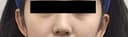 눈밑필러잘하는곳에서 받고 다크서클 느낌 많이 줄었어요ㅋㅋ