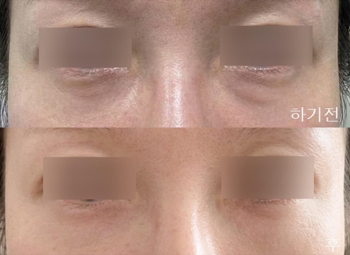 눈밑 결절, 눈밑결절제거로 해결했어요