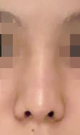 หลังจากผ่าตัดแก้ไขสันจมูก ปลายจมูก และจมูกที่ใหญ่เกินไป ผ่านไป 3 เดือน จมูกของฉันก็ดูเรียวขึ้นค่ะ