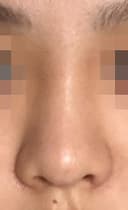 콧대+코끝+복코교정 3개월, 코가 얄쌍해졌어요