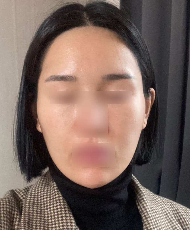 ฉันกลับมามีใบหน้าที่เปล่งปลั่งอีกครั้งด้วยการปลูกถ่ายไขมันทั่วใบหน้า