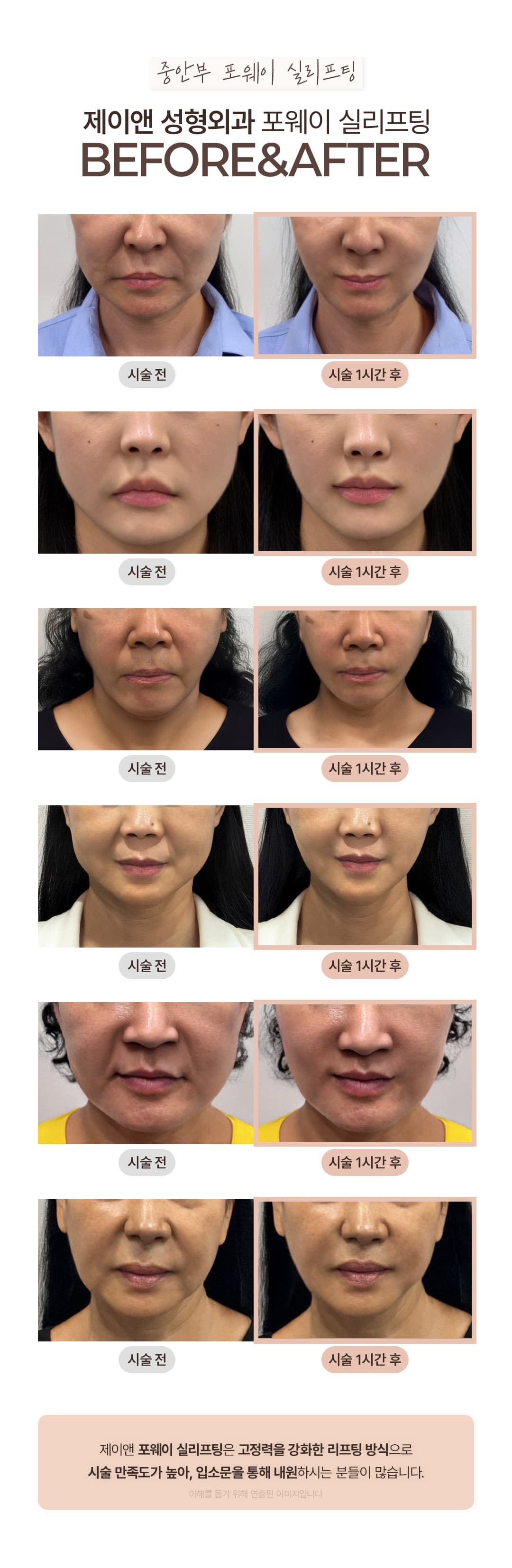 -중안부 실리프팅- 단 1줄로 4번 리프팅 하는 포웨이 실리프팅 4