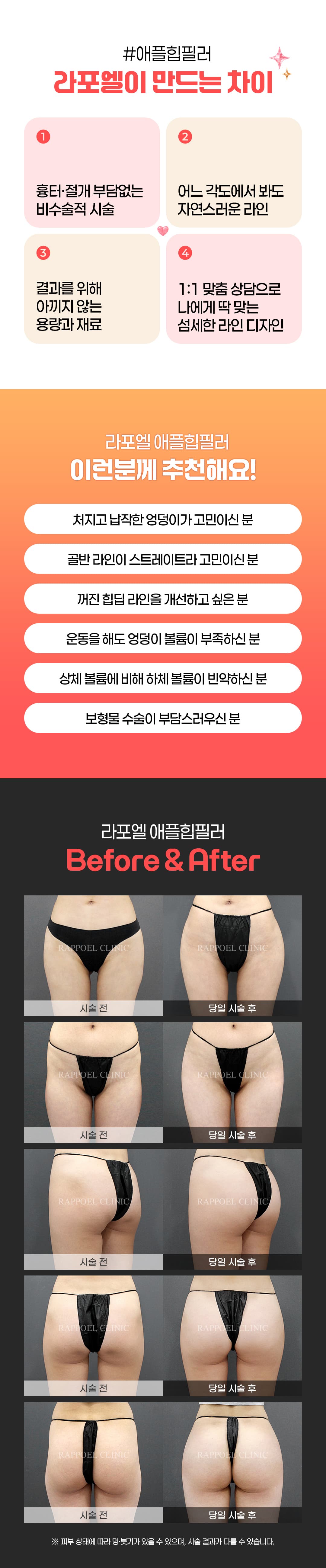 대용량 애플힙필러 - 골반필러,힙딥필러,힙업필러,엉덩이필러-라포엘의원 이주형 대표원장 2
