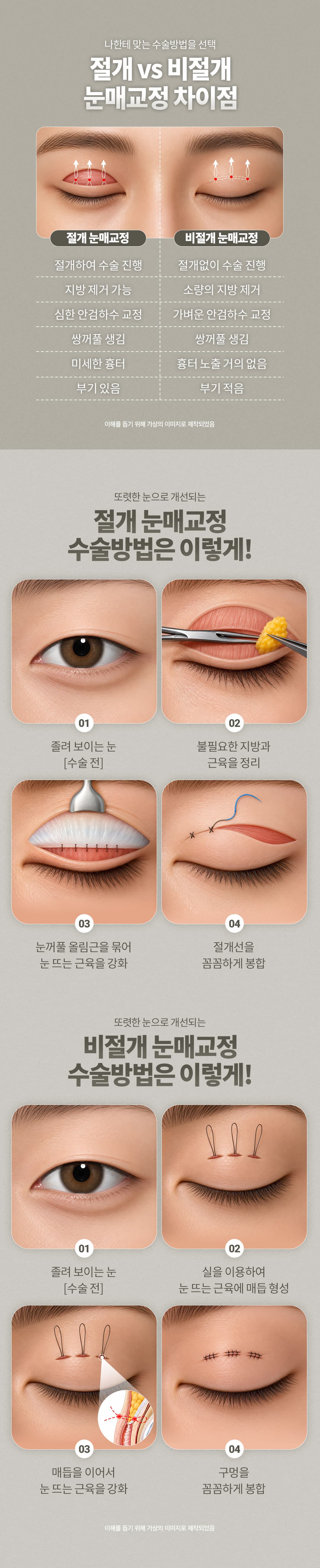 Điều chỉnh mí mắt DM 4