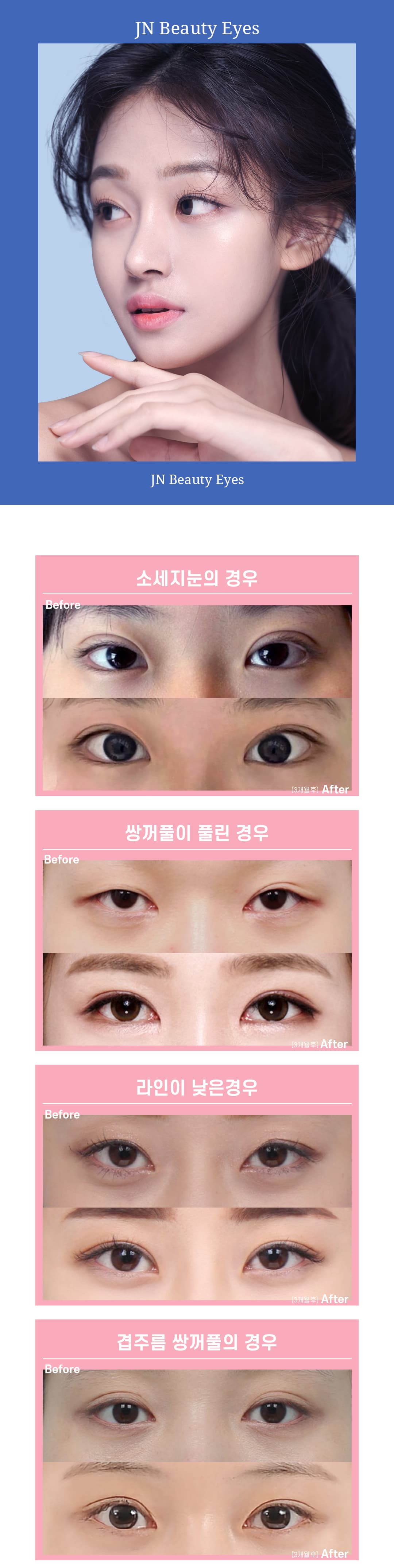 J&J Eye Revision Surgery 2