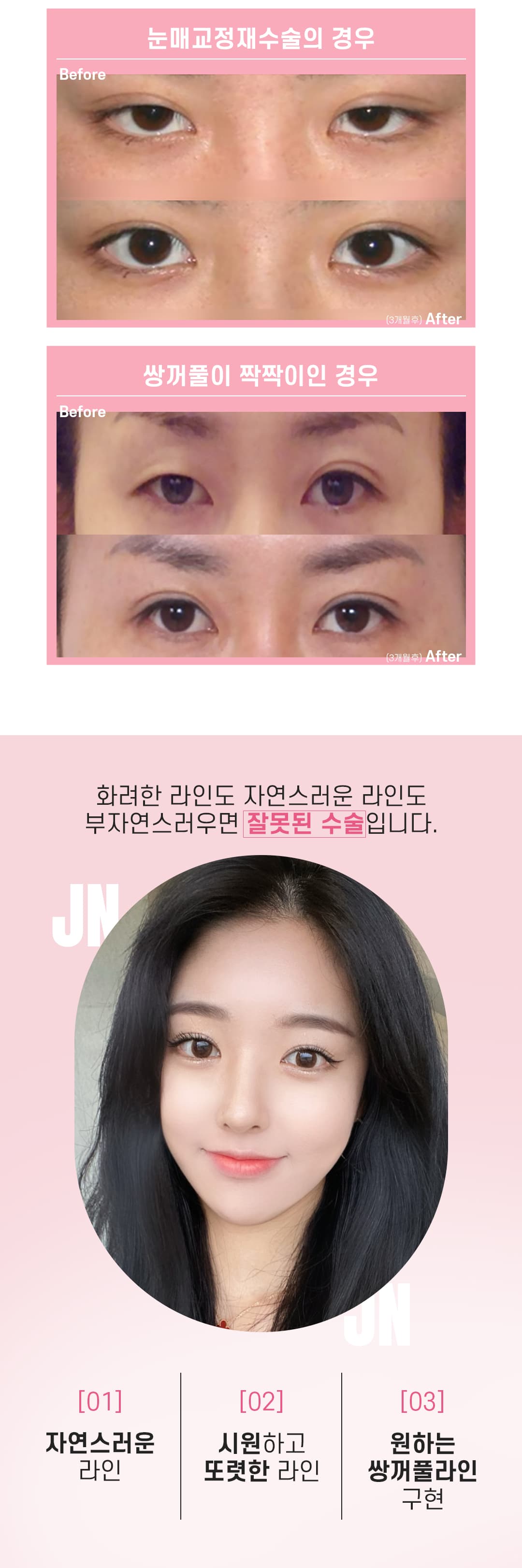 J&J Eye Revision Surgery 3