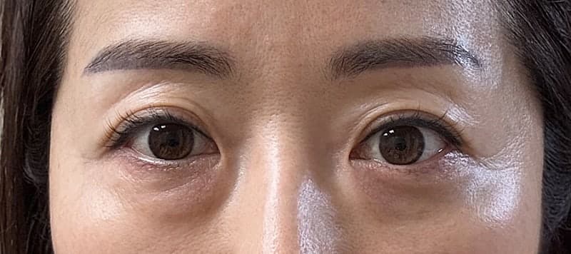 눈밑지하고 피부까지 좋아짐ㅎ 오브제 박시현원장님 1