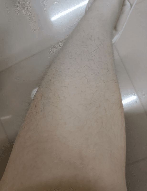 청주피부과 제모 어디서 하세요? 1