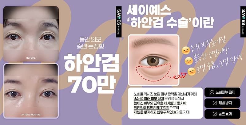 하안검수술후기 하안검수술비용 70만원으로 눈밑주름없애는방법 2