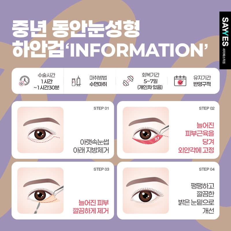 하안검수술후기 하안검수술비용 70만원으로 눈밑주름없애는방법 4