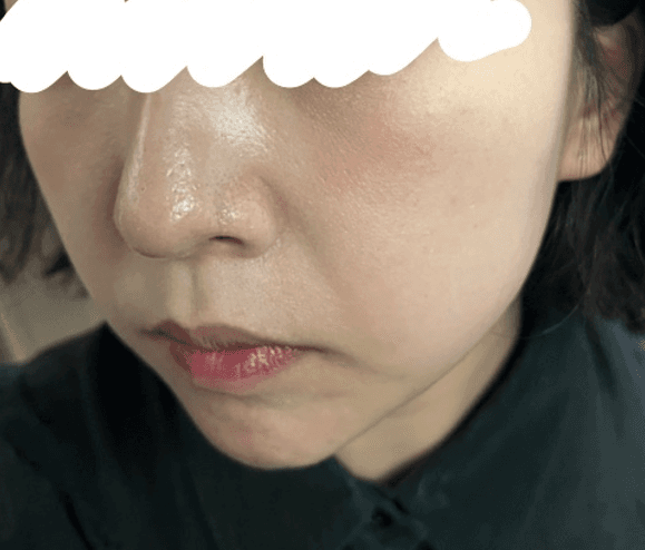 나비존 모공축소 후기😊 아디떼 스킨부스터 1번만해도 엄청 좋아졌어요 1